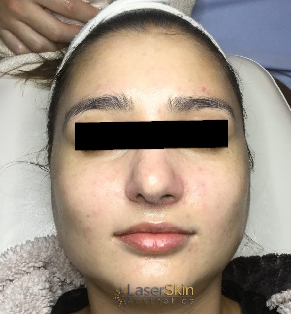 Before-Acne