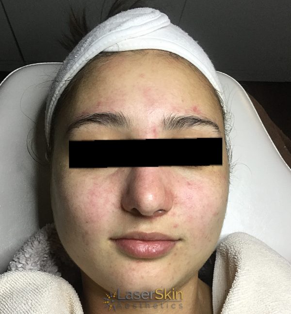 After-Acne