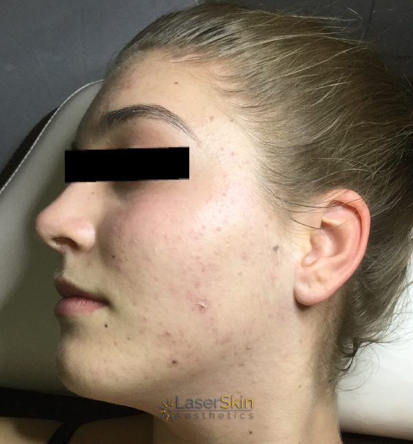 Before-Acnethree