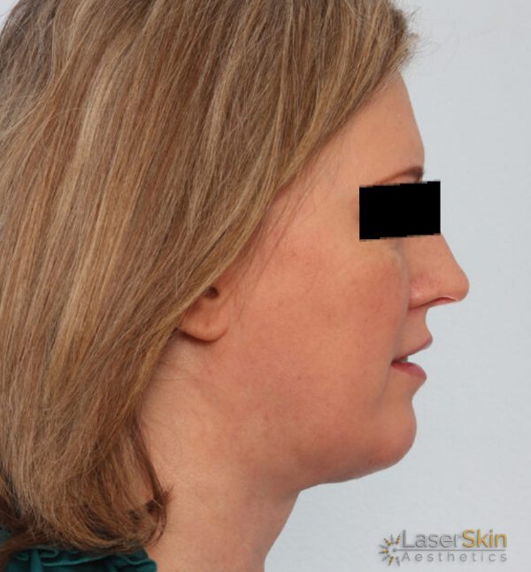 Before-Neckliftb&a1