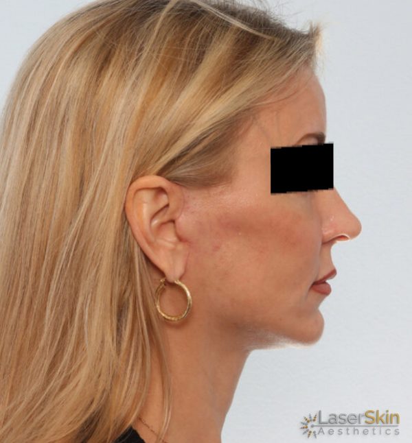 Before-Neckliftb&a3