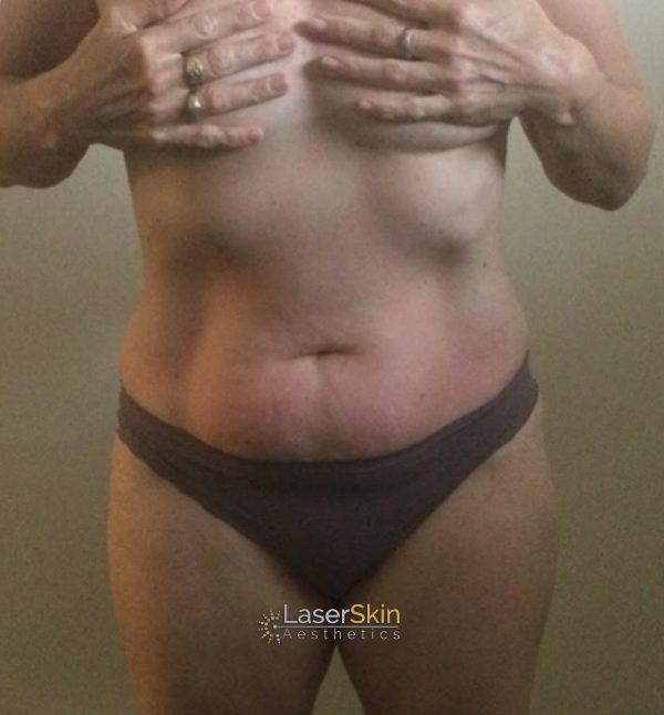 Before-Body Contouring B&A 2