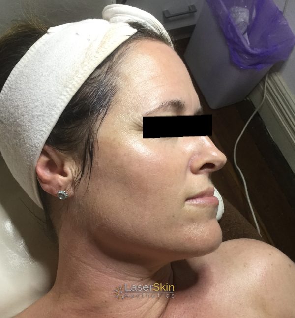 Before-faceliftB&A1
