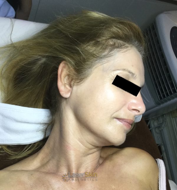 Before-faceliftB&A2