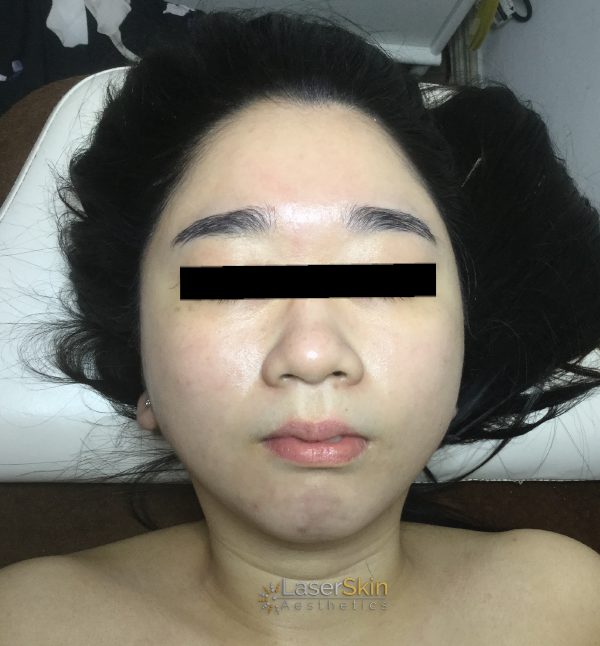 Before-faceliftB&A3
