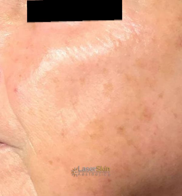 Before-Finelines & Wrinkles 1