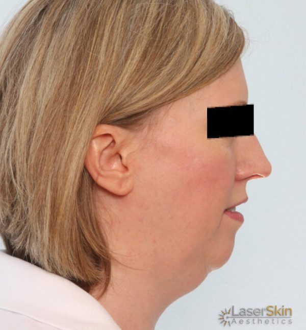 After-Neckliftb&a1