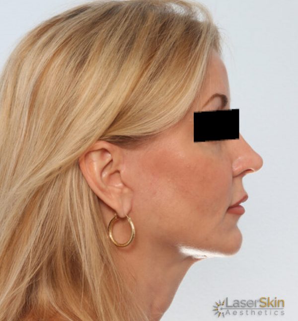 After-Neckliftb&a3
