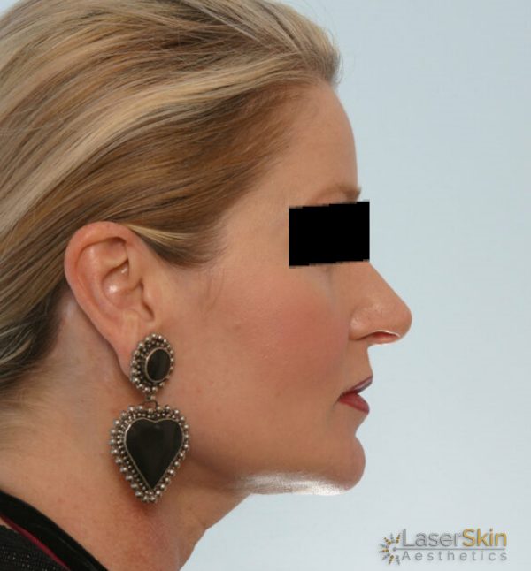After-Neckliftb&a2