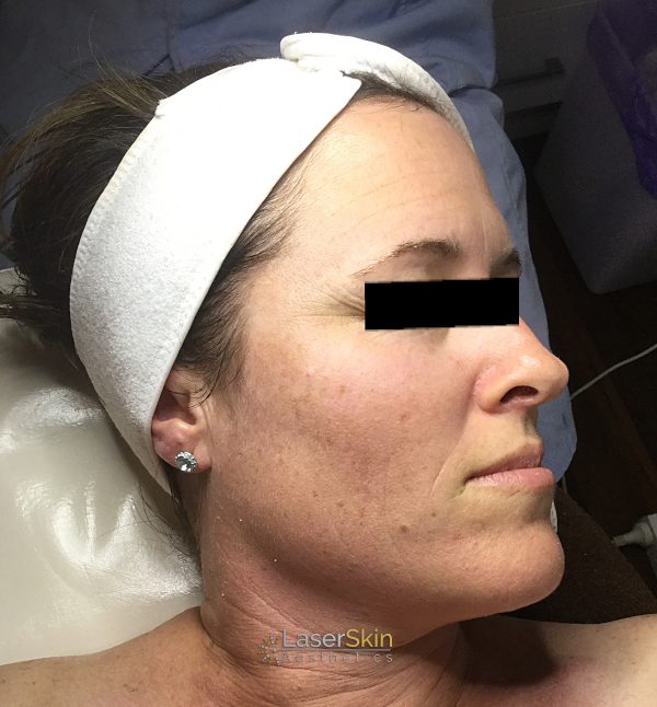 After-faceliftB&A1