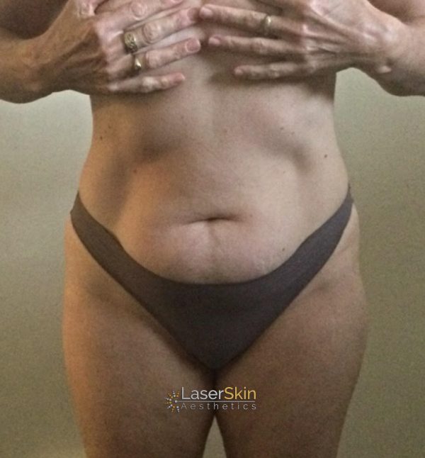 After-Body Contouring B&A 2