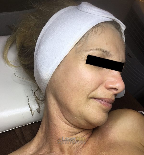 After-faceliftB&A2
