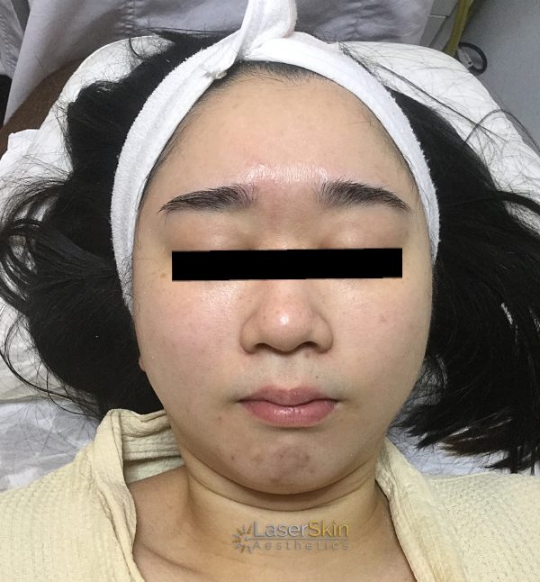 After-faceliftB&A3
