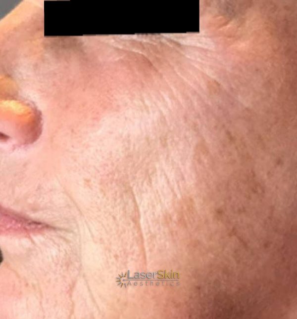 After-Finelines & Wrinkles 1