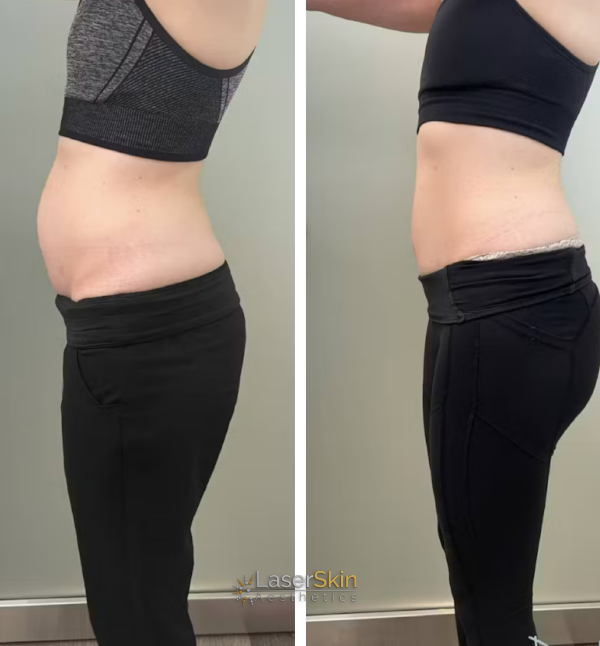 Body Contouring before and after mobile 2
