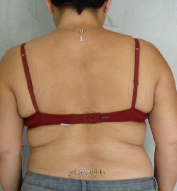Before-Body Contouring B&A 3