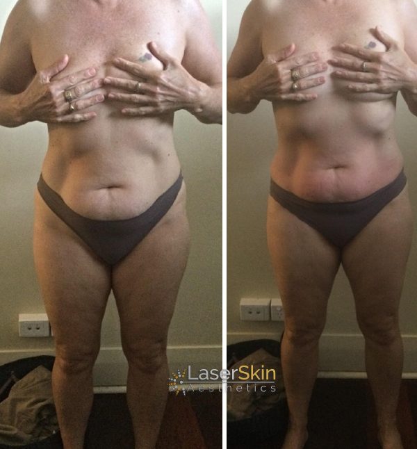 Body contouring before and after mobile 1