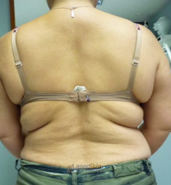 After-Body Contouring B&A 3