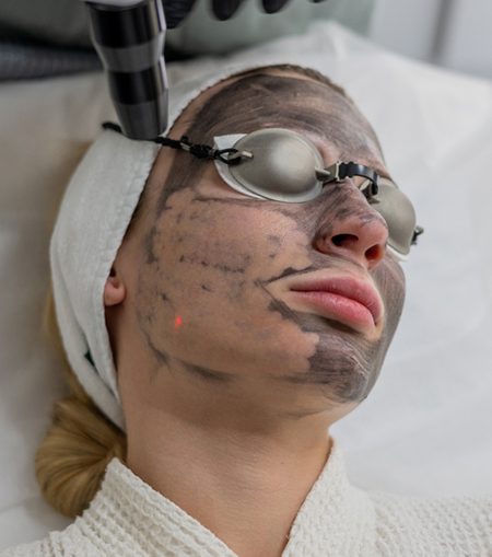 Carbon Laser Peel Treatment Image Carbon Laser Peel Treatment Image