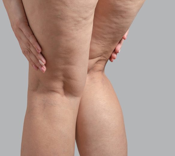 Cellulite Reduction Head Picture