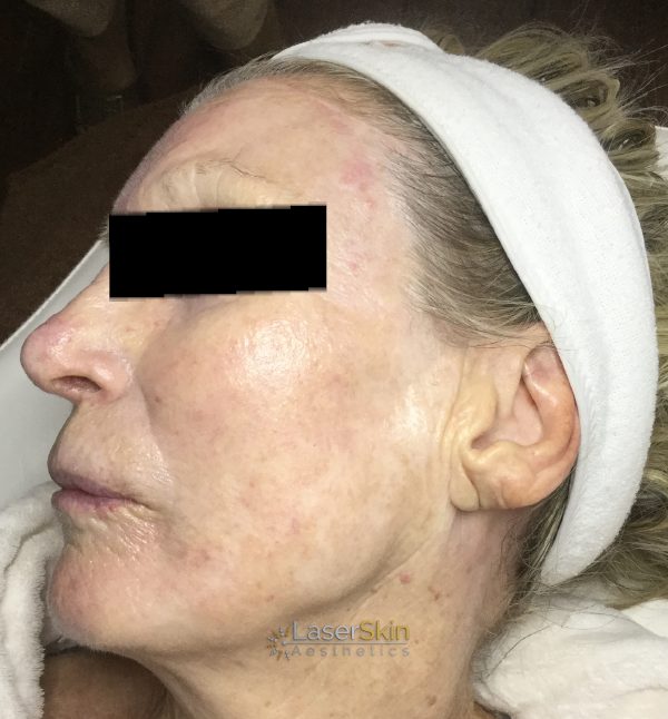 Before-Finelines & Wrinkles 3