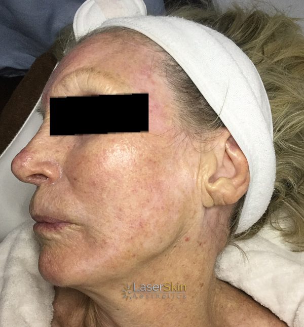 After-Finelines & Wrinkles 3