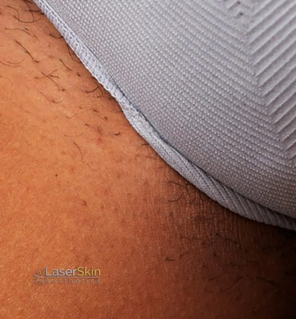 After-Laser Hair Removal B&A1