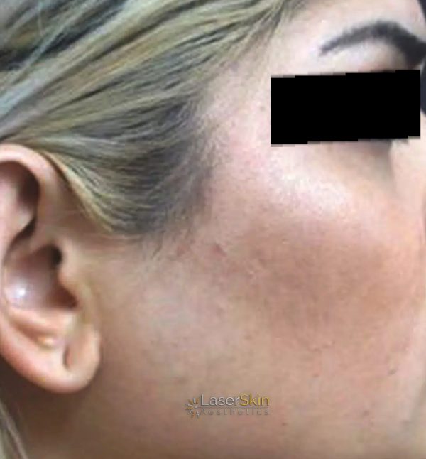 Before-Laser Hair Removal B&A2