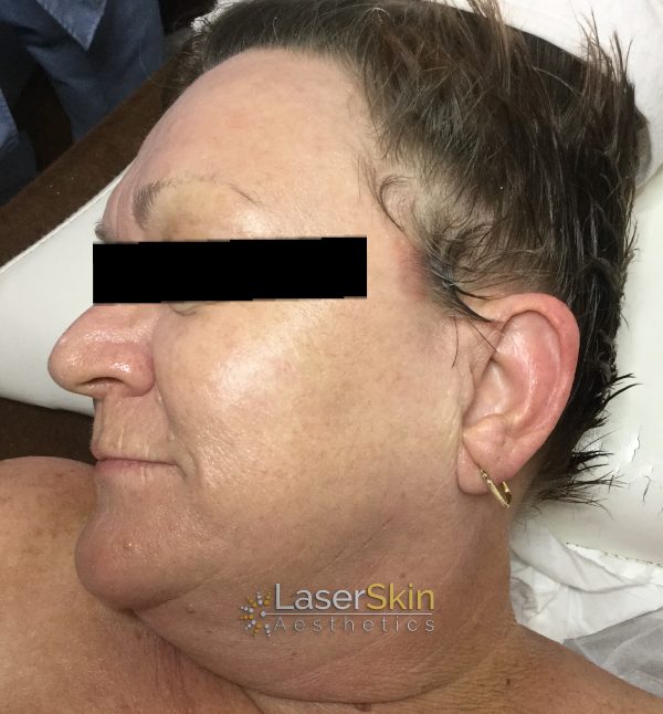 Before-Pigmentation B&A1
