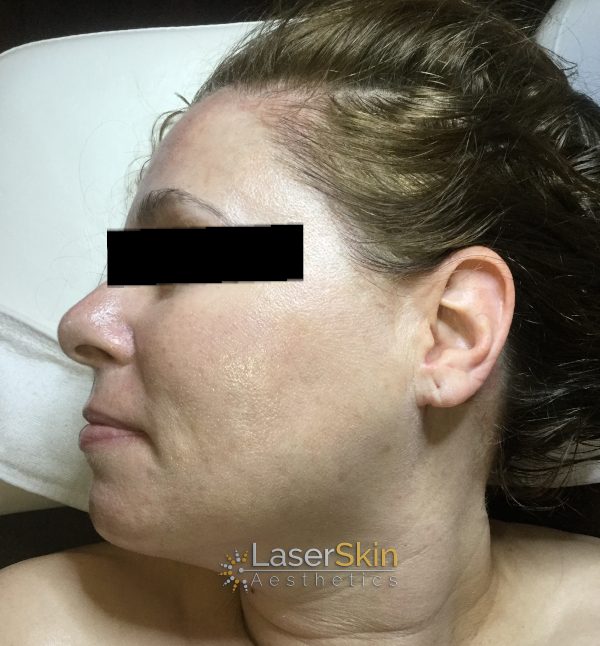 Before-Pigmentation B&A3