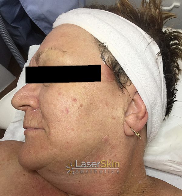 After-Pigmentation B&A1