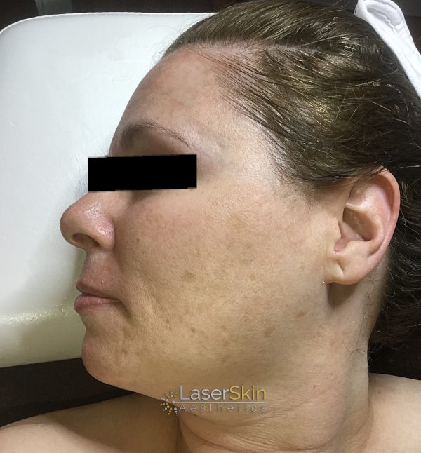 After-Pigmentation B&A3