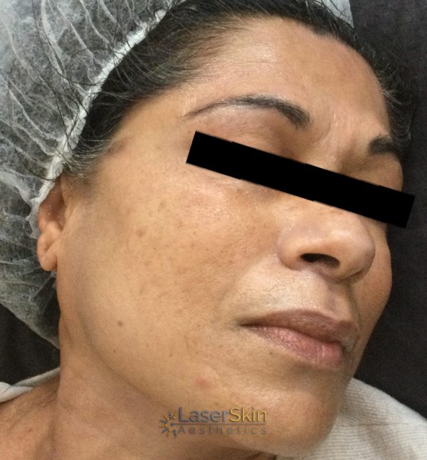 Before-RF Skin Tightening One