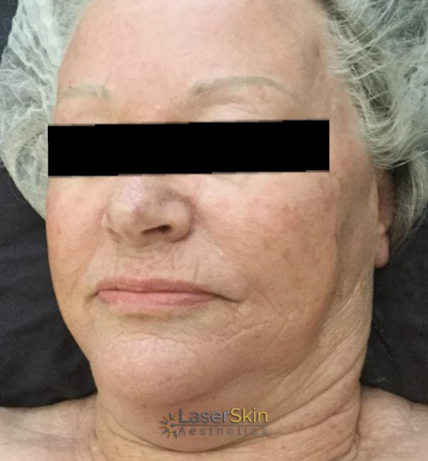 Before-RF Skin Tightening Three