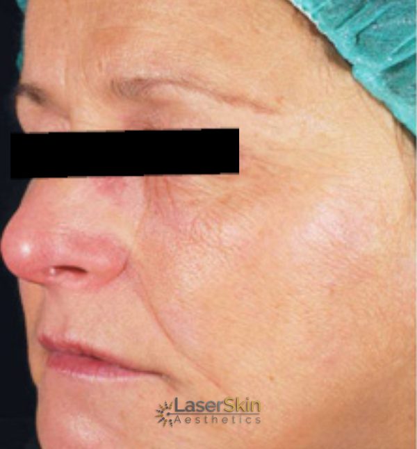 After-RF Skin One