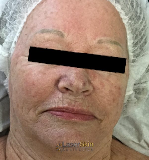 After-RF Skin Tightening Three