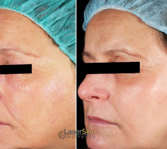 RF Skin Tightening Mobile Before and After 3
