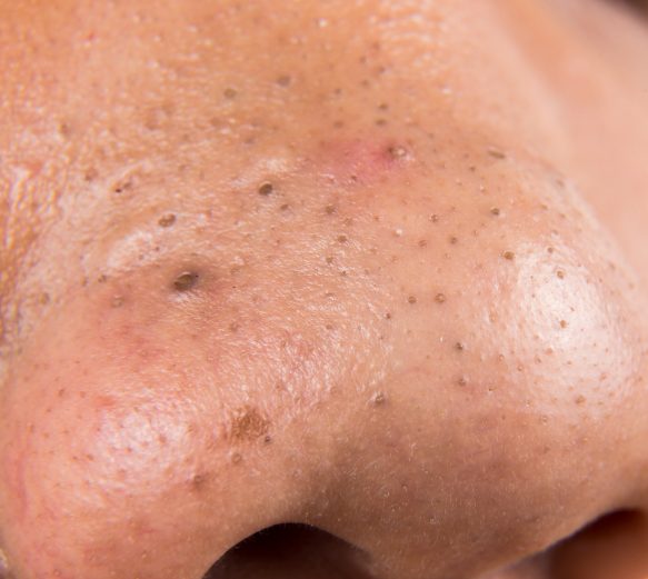 Signs of Acne - Blackheads Signs of Acne - Blackheads