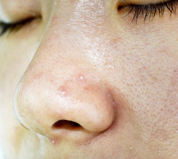 Signs of Acne - Whiteheads Signs of Acne - Whiteheads
