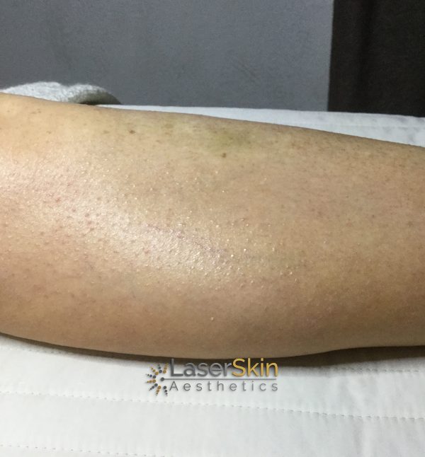 Before-Vascular Two