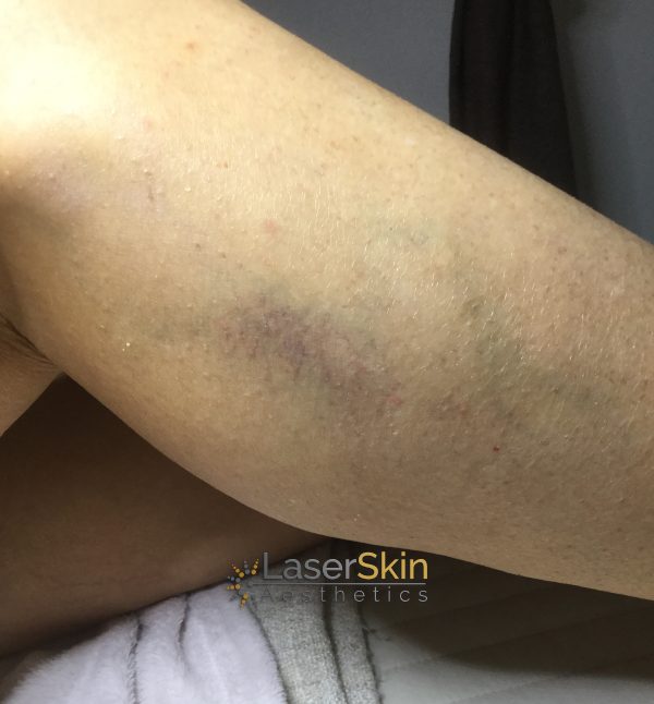After-Vascular Two