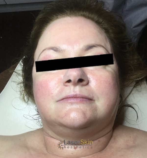 Before-Vascular One