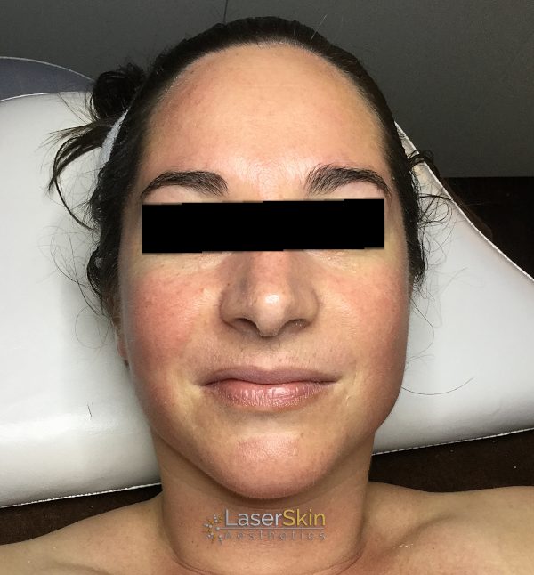 After-Pigmentation B&A2