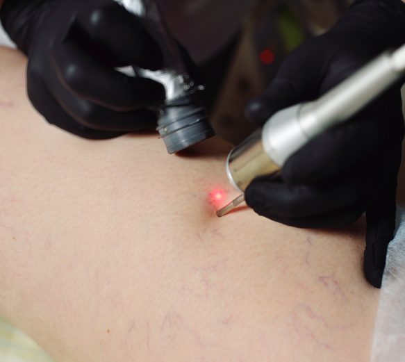 Laser Vascular Removal Skin Concern Laser Vascular Removal Skin Concern