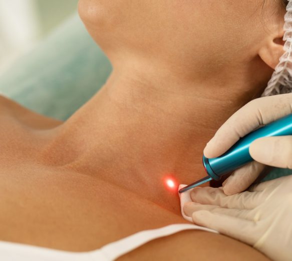 Pigmetnation removal skin concerns Skin Concerns - Ageing - Pigmentation Removal