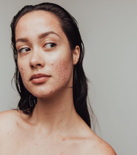Skin Concerns - What causes acne Skin Concerns - What causes acne
