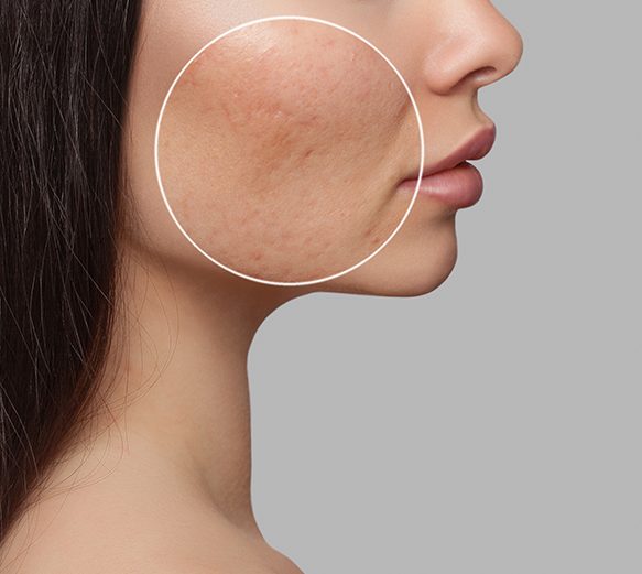 Acne Scarring