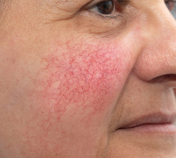 Laser Redness Roscosa Removal