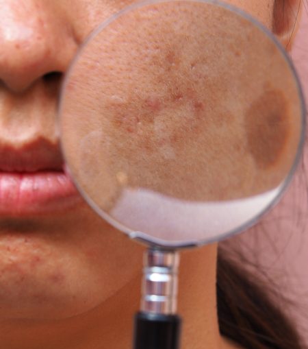 What Causes Pigmentation