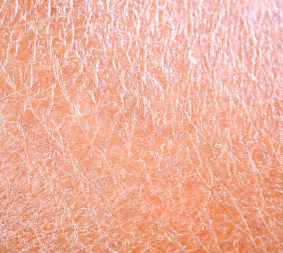 Dry Dehydrated Skin